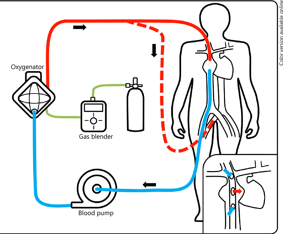 ECMO 